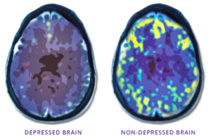 brain scans compare a depressed brain and a non depressed brain showing the changes in function 