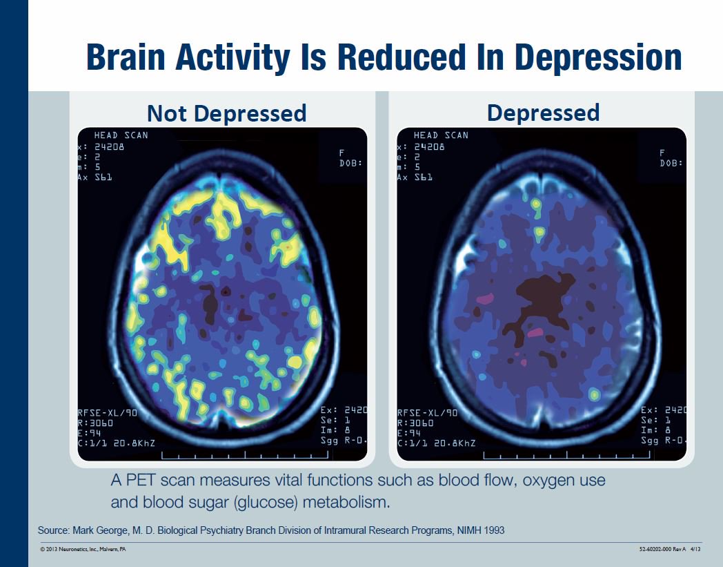 Side-by-side images of a PET scan shows areas of the brain lighting up in a non-depressed brain, then a depressed brain with much less light